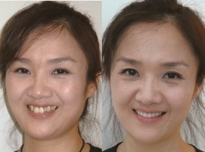 韩国牙齿整形美白，受中国人欢迎